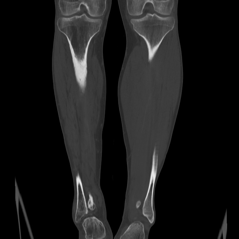 Brodie abscess - tibia (Radiopaedia 66028-75204 Coronal bone window 44).jpg