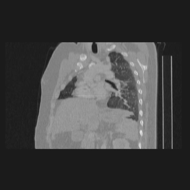 Bronchial atresia (Radiopaedia 60685-68439 Sagittal lung window 50).jpg