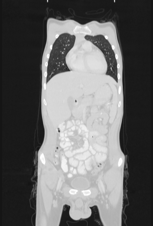 Bronchial carcinoid tumor (Radiopaedia 57187-64090 Coronal lung window 23).jpg