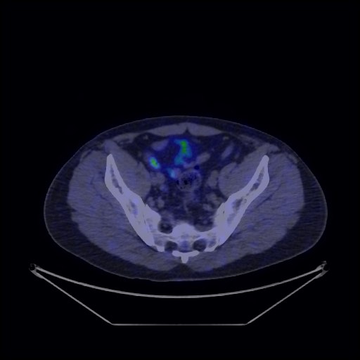 Bronchial carcinoid tumor (Radiopaedia 67377-76765 68Ga-DOTATATE PET-CT 67).jpg