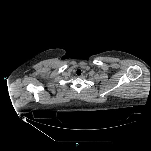 Bronchial carcinoid tumor (Radiopaedia 78272-90870 Axial non-contrast 7).jpg