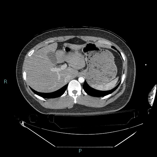 Bronchial carcinoid tumor (Radiopaedia 78272-90870 B 112).jpg