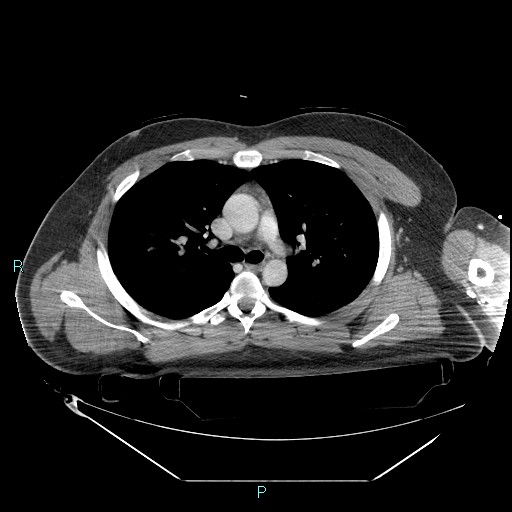 File:Bronchial carcinoid tumor (Radiopaedia 78272-90870 C 48).jpg