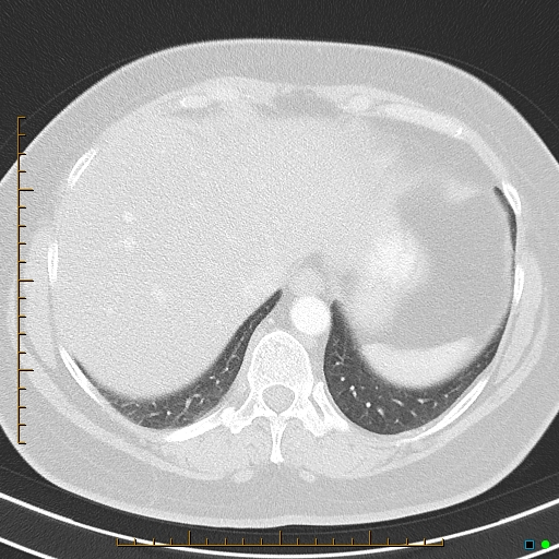 Bronchial diverticula (Radiopaedia 79512-92675 Axial lung window 41).jpg