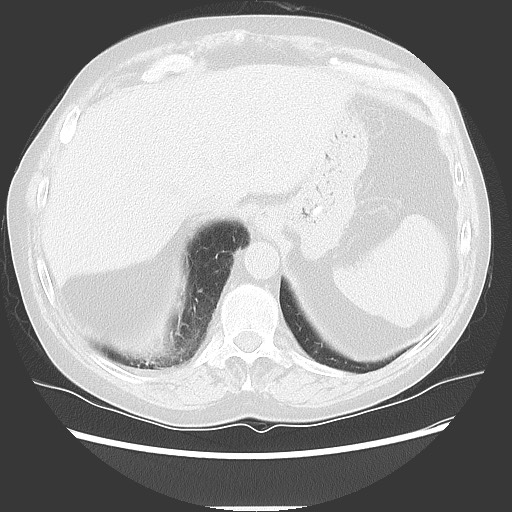 Bronchial stenosis - lung transplant (Radiopaedia 73133-83848 Axial lung window 53).jpg