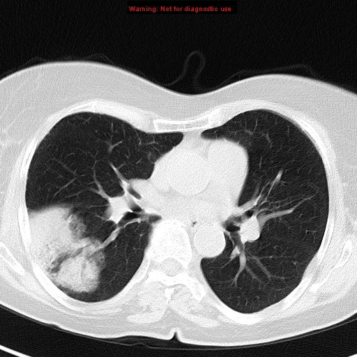 File:Bronchoalveolar carcinoma (BAC) (Radiopaedia 13436-13392 Axial lung window 26).jpg
