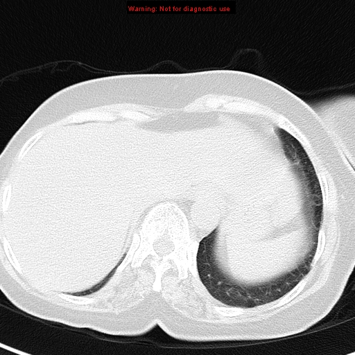 File:Bronchoalveolar carcinoma (BAC) (Radiopaedia 13436-13392 Axial lung window 43).jpg