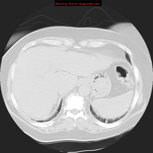 Bronchoalveolar carcinoma (Radiopaedia 13224-13233 Axial lung window 38).jpg