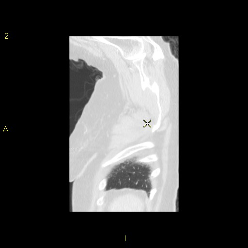 File:Bronchogenic carcinoma as an incidental finding (Radiopaedia 16453-16130 Sagittal lung window 6).jpg