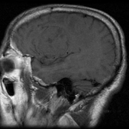 File:Bronchogenic carcinoma brain metastasis (Radiopaedia 9286-9969 Sagittal T1 1).jpg