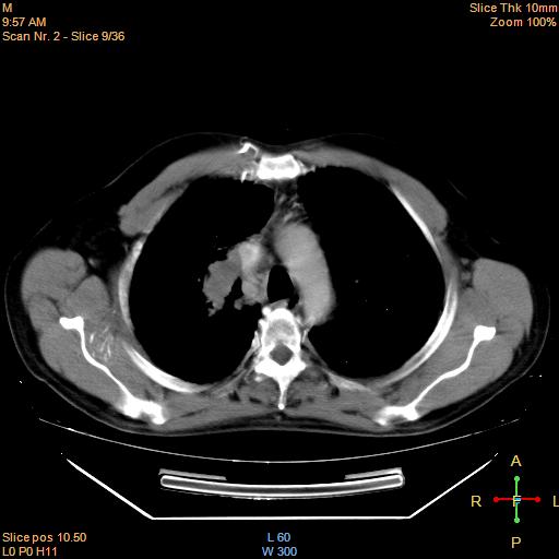 File:Bronchogenic carcinoma with superior vena caval invasion (Radiopaedia 22378-22406 Axial liver window 7).jpg