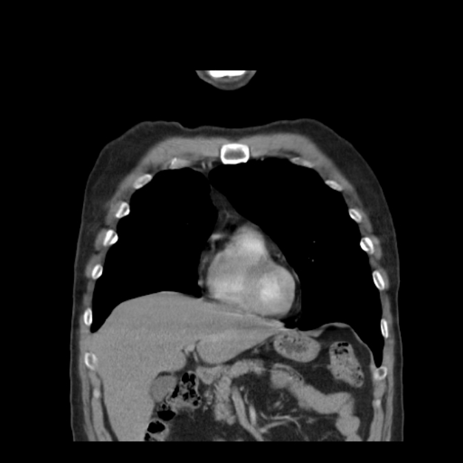 Bronchogenic carcinoma with upper lobe collapse (Radiopaedia 29297-29726 D 18).jpg