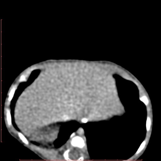 Bronchogenic cyst (Radiopaedia 78599-91409 B 166).jpg