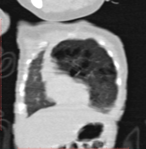 Bronchogenic cyst (Radiopaedia 78599-91409 Coronal lung window 46).jpg