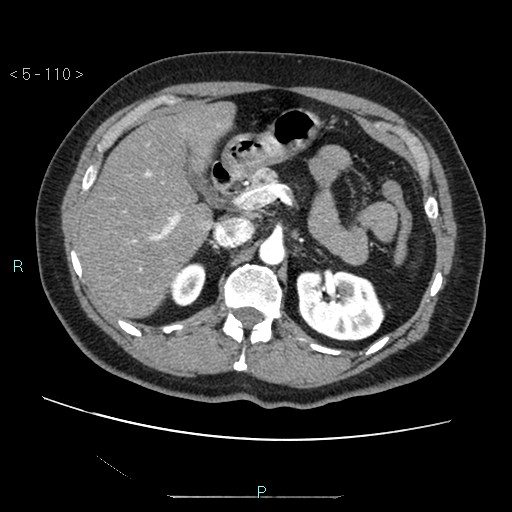 Bronchogenic cyst - posterior mediastinal (Radiopaedia 43885-47364 A 64).jpg