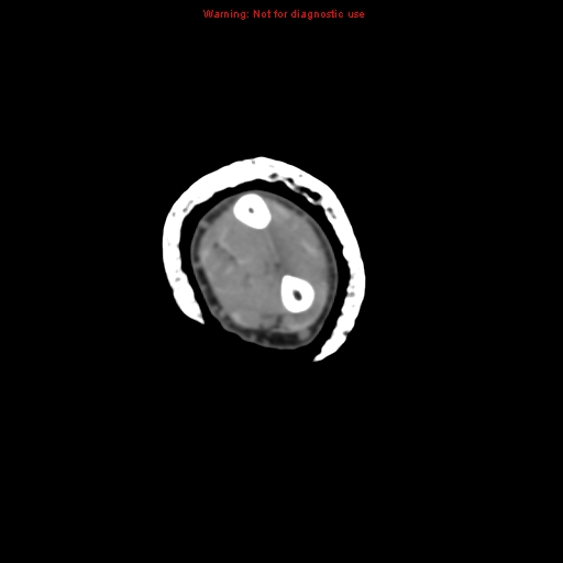 File:Brown tumor (Radiopaedia 12460-12694 Axial non-contrast 70).jpg