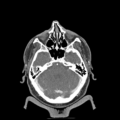 Buccal fat pad arteriovenous malformation (Radiopaedia 70936-81144 D 264).jpg