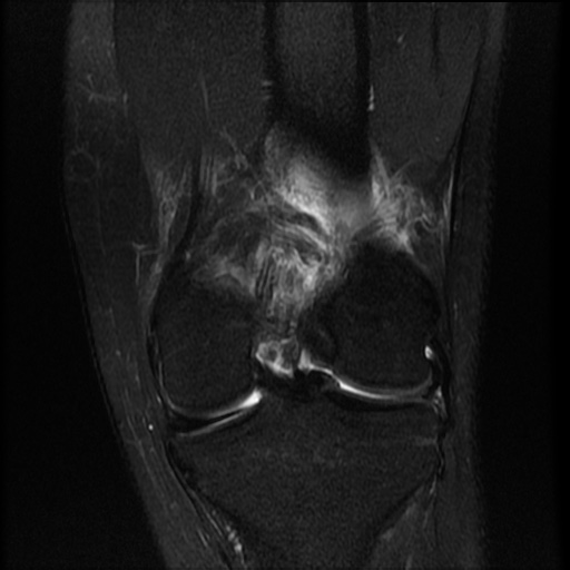 File:Bucket-handle meniscus tear (Radiopaedia 65700-74809 Coronal T2 fat sat 8).jpg