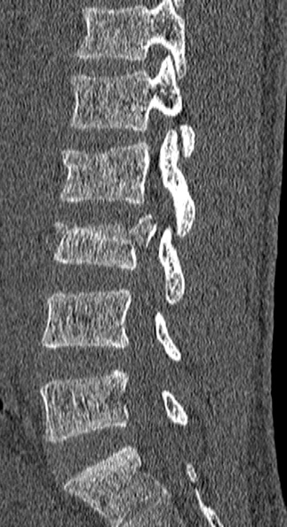 Burst fracture (Radiopaedia 53373-59357 Sagittal bone window 45).jpg