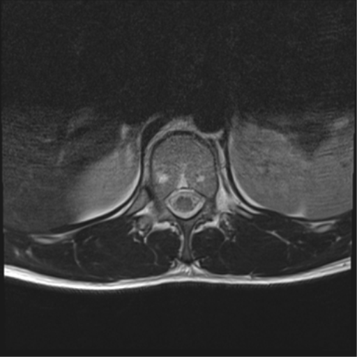 File:Burst fracture - T12 with conus compression (Radiopaedia 56825-63646 Axial T2 20).png