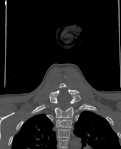 File:Butterfly vertebra (Radiopaedia 77903-90209 Coronal bone window 61).jpg