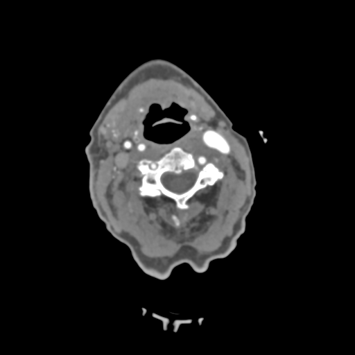 File:C2 fracture with vertebral artery dissection (Radiopaedia 37378-39200 A 144).png