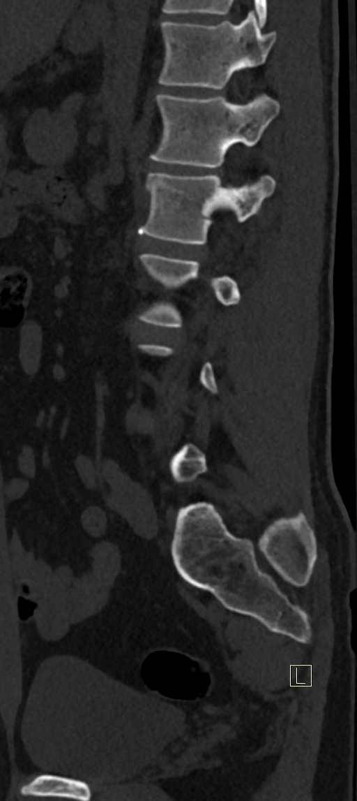 Calcaneal fractures with associated L2 burst fracture (Radiopaedia 71671-82493 Sagittal bone window 20).jpg