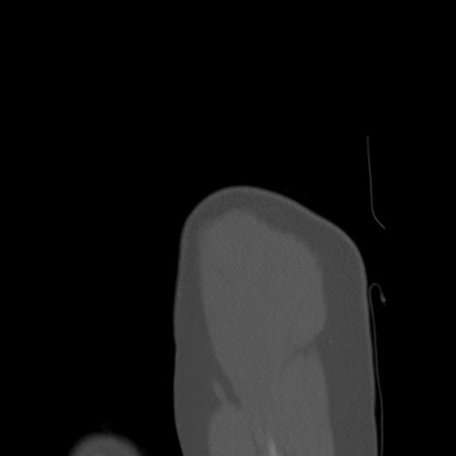 File:Calcific tendinitis of the infraspinatus tendon (Radiopaedia 87256-103539 Sagittal bone window 12).jpg