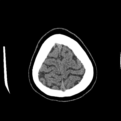 Calcified cerebral hydatid cyst (Radiopaedia 65603-74717 Axial non-contrast 73).jpg