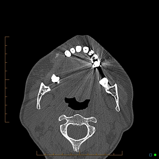 Calcified facial augmentation fillers (Radiopaedia 79514-92679 Axial bone window 103).jpg