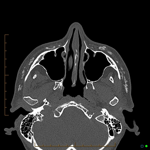 Calcified facial augmentation fillers (Radiopaedia 79514-92679 Axial bone window 26).jpg