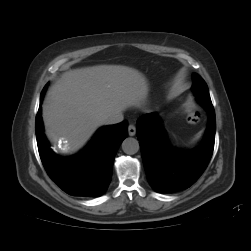 File:Calcified hepatic hydatid cyst (Radiopaedia 18907-18853 Axial non-contrast 4).jpg
