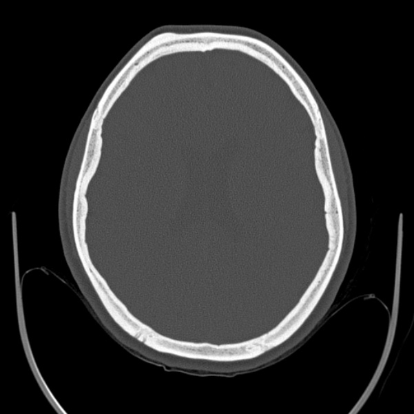 Calvarial osteoma (Radiopaedia 36520-38079 Axial bone window 66).jpg