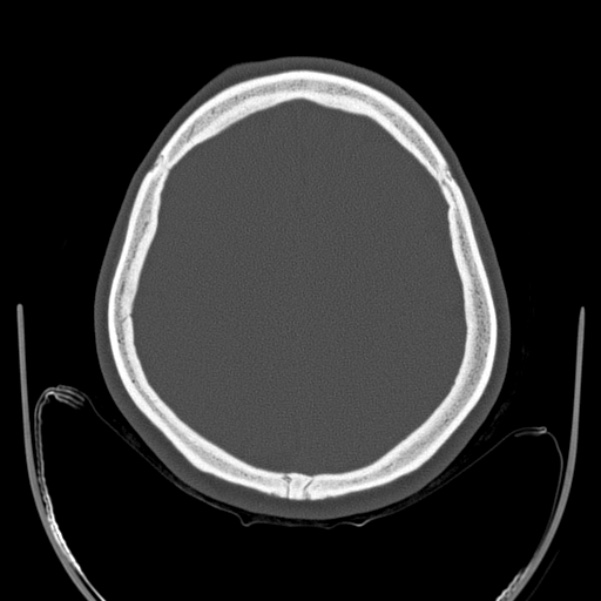 Calvarial osteoma (Radiopaedia 36520-38079 Axial bone window 79).jpg