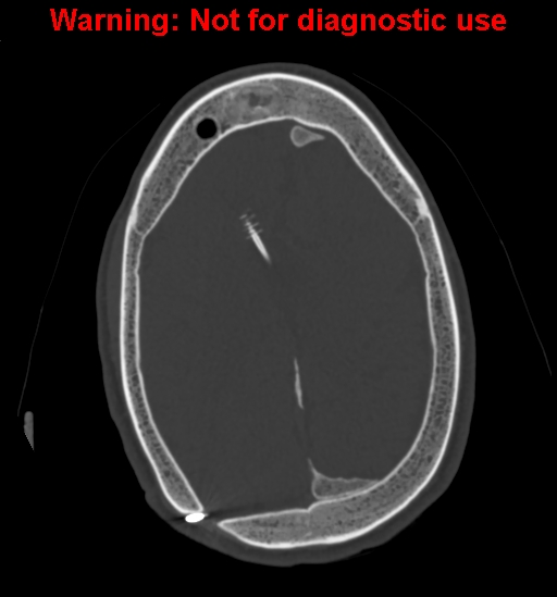 Calvarial thickening from chronic shunting (Radiopaedia 60079-67637 Axial bone window 128).jpg