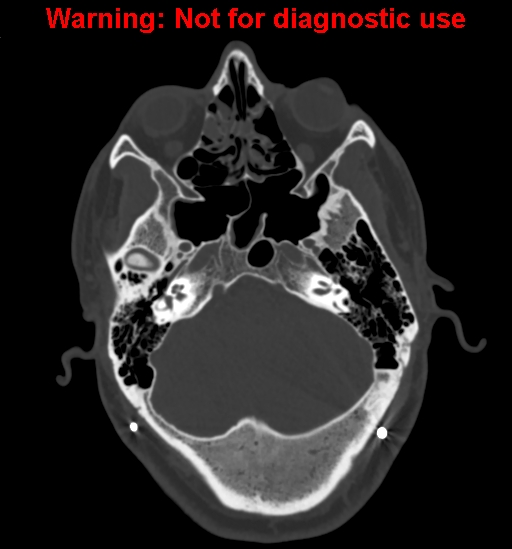 Calvarial thickening from chronic shunting (Radiopaedia 60079-67637 Axial bone window 40).jpg
