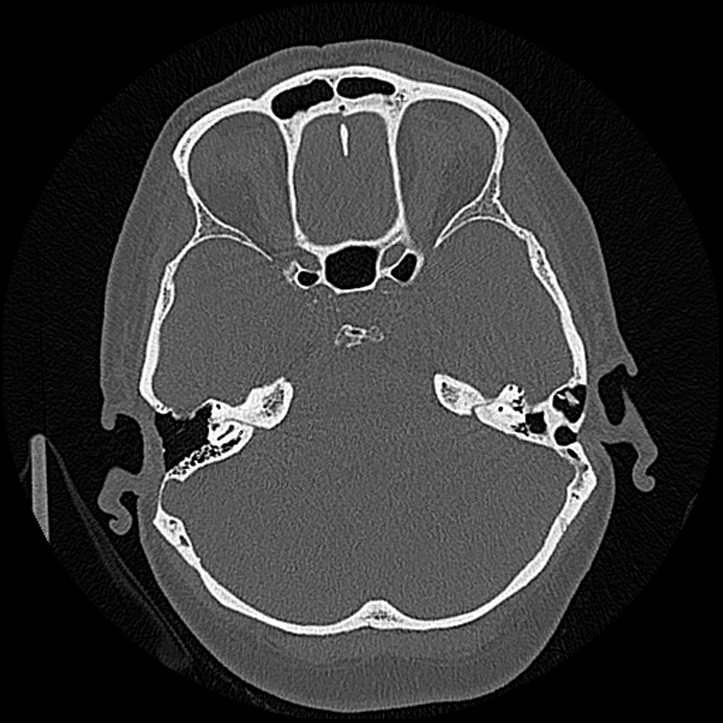 Canal up mastoidectomy (Radiopaedia 78108-90638 Axial bone window 97).jpg