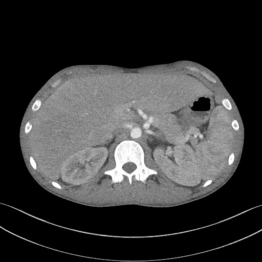 Cannonball metastases - testicular choriocarcinoma (Radiopaedia 84510-99891 B 110).jpg