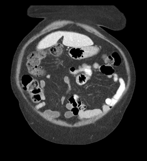 File:Cannonball metastases from endometrial cancer (Radiopaedia 42003-45031 F 16).png