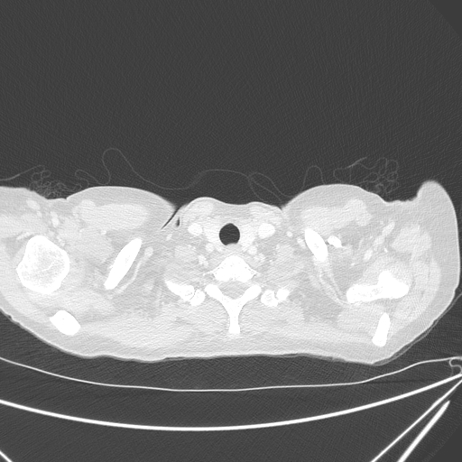 Canonball lung metastasis (Radiopaedia 77634-89837 Axial lung window 6).jpg