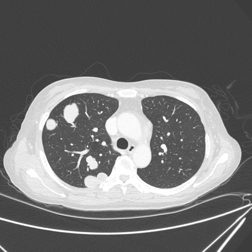 File:Canonball lung metastasis (Radiopaedia 77634-89837 Axial lung window 60).jpg