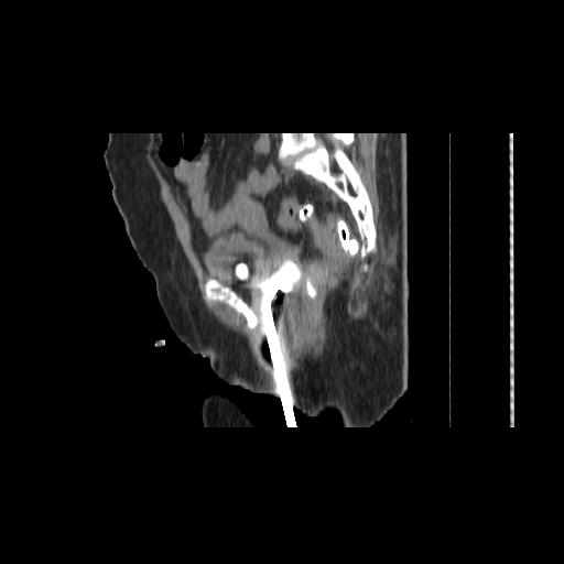 File:Carcinoma cervix- brachytherapy applicator (Radiopaedia 33135-34173 D 107).jpg