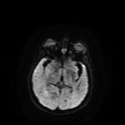Carcinoma ex-pleomorphic adenoma of parotid (Radiopaedia 28383-28627 Ax DWI B-500 GE 71).jpg