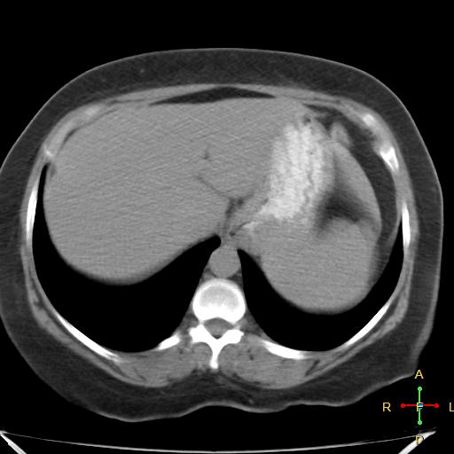 File:Carcinoma of sigmoid colon (Radiopaedia 23071-23100 C+ delayed 3).jpg