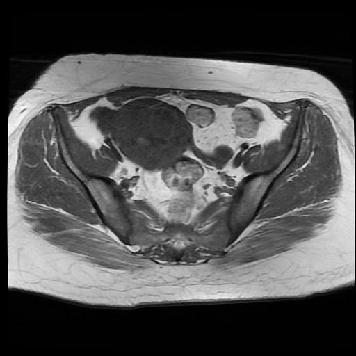 File:Carcinoma of the cervix (Radiopaedia 89018-105858 Axial T1 5).jpg
