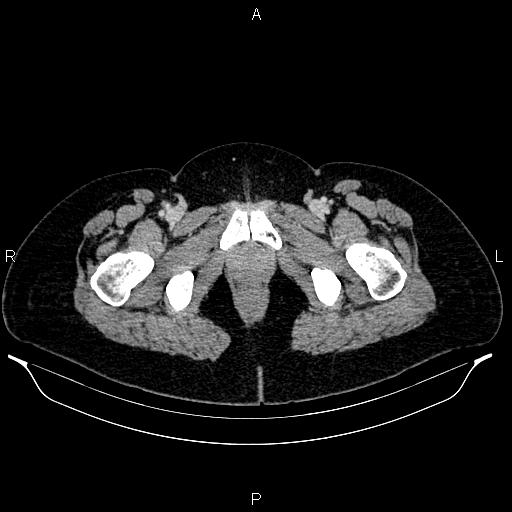 Carcinoma of uterine cervix (Radiopaedia 85861-101700 A 77).jpg