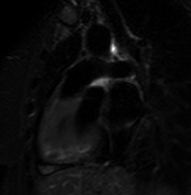File:Cardiac sarcoidosis (Radiopaedia 74548-85466 2ch STIR 7).jpg