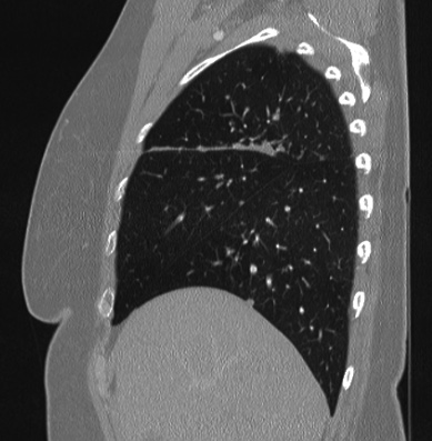 Cardiac sarcoidosis (Radiopaedia 74548-85534 Sagittal lung window 73).jpg