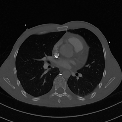 Cardiac tumor - undifferentiated pleomorphic sarcoma (Radiopaedia 45844-50134 Axial bone window 36).png