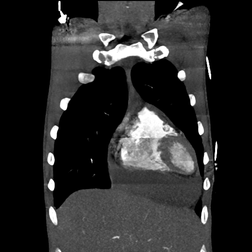 Cardiac tumor - undifferentiated pleomorphic sarcoma (Radiopaedia 45844-50134 Coronal non-contrast 14).png